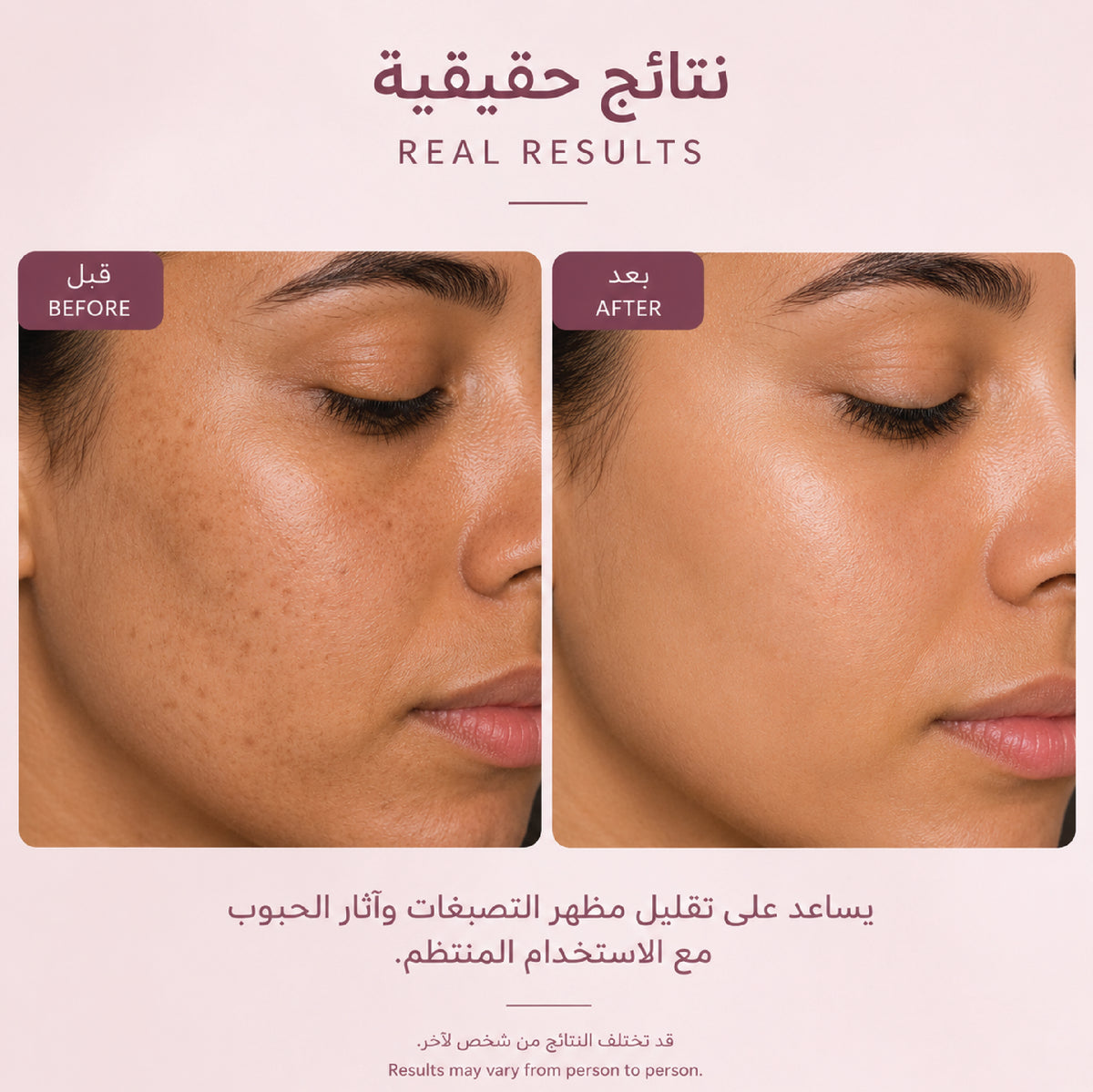 كريم التفتيح للتصبغات وآثار الحبوب | 250ml