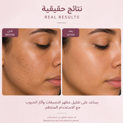 كريم التفتيح للتصبغات وآثار الحبوب | 250ml